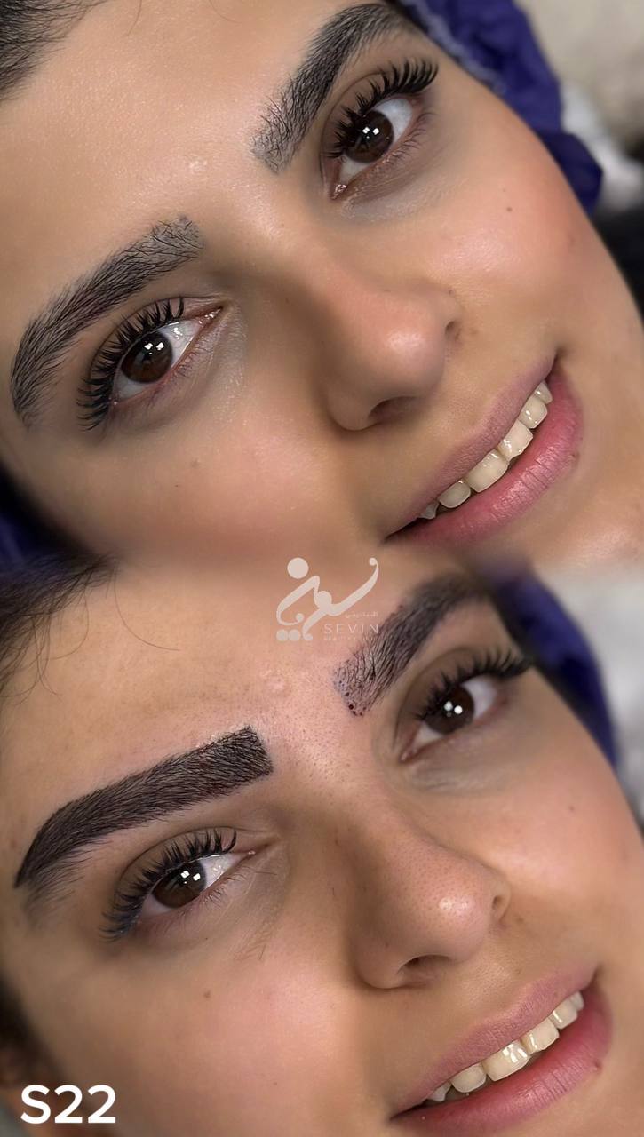 نمونه کاشت ابرو در کلینیک سوین